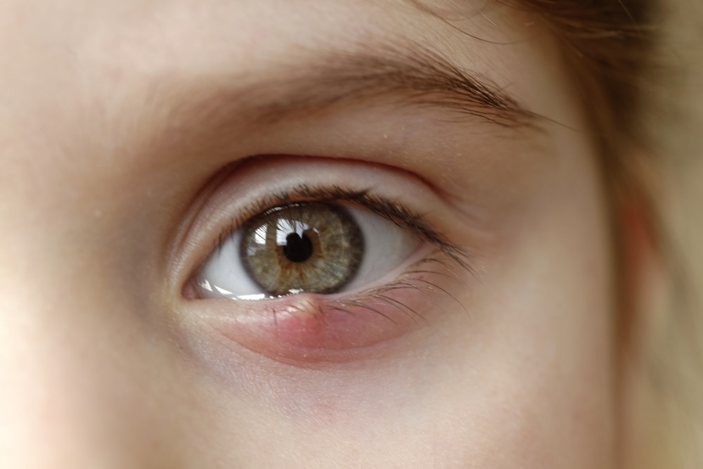 Stye Eye Causes