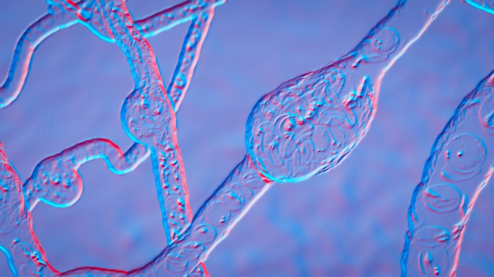 Diabetic Retinopathy