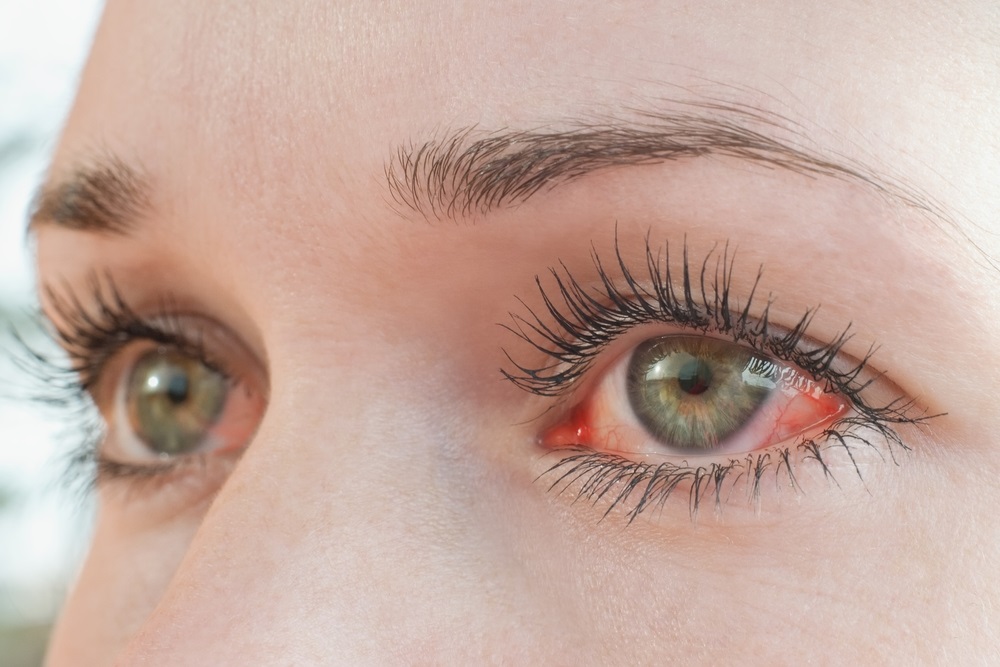 Alergias oculares